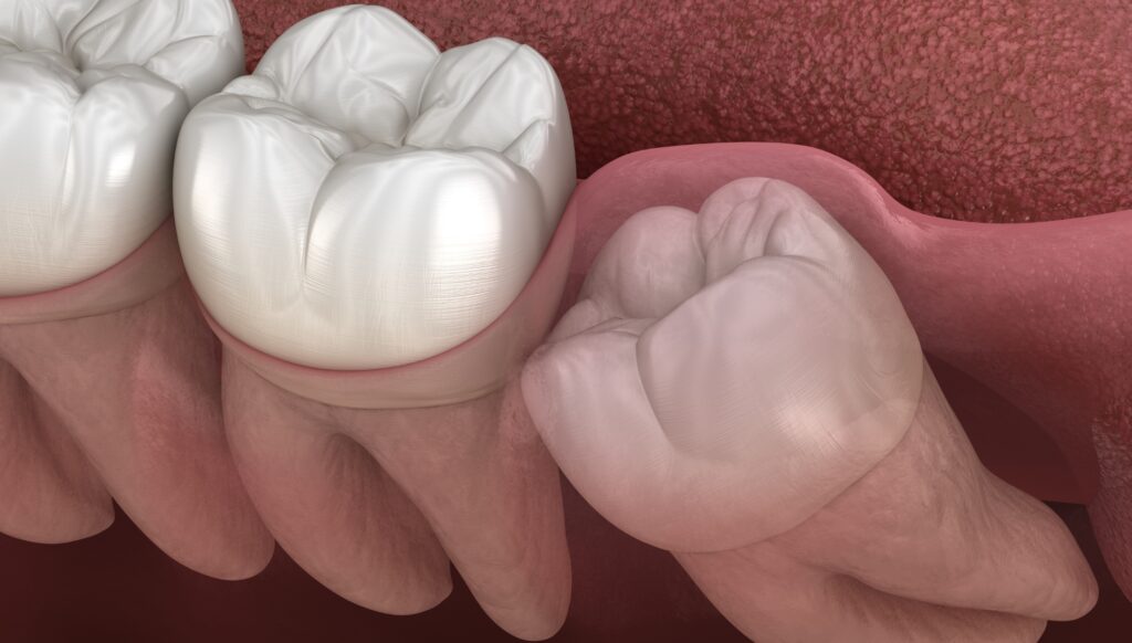 Illustration of wisdom teeth removal at Mary St Dental Gympie – Expert oral surgery for Sunshine Coast and Gympie patients.