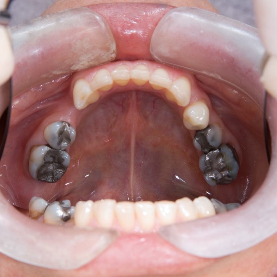 Mary St Dental Gympie full mouth rehabilitation for worn, short, and collapsed teeth restoration