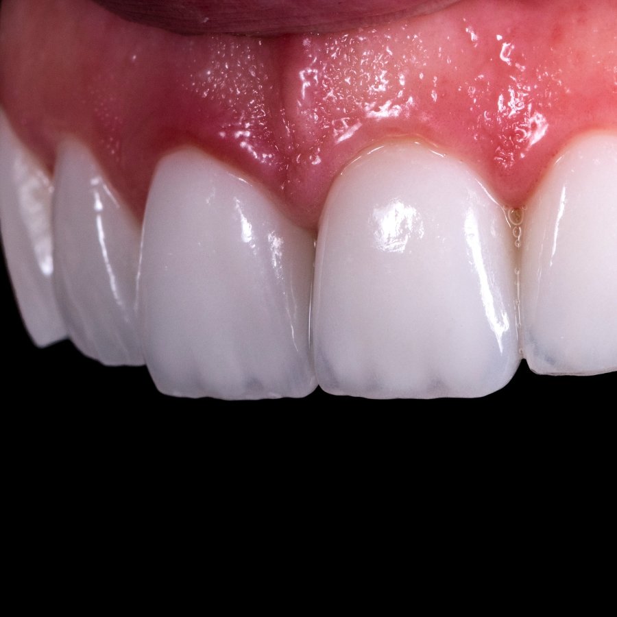 Professional porcelain veneers at Mary St Dental Gympie delivering custom smile enhancement with precision-crafted cosmetic solutions