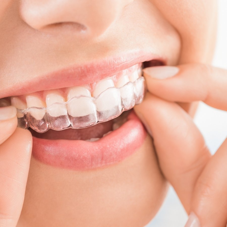 Professional Invisalign clear aligner treatment at Mary St Dental Gympie providing discreet orthodontic solutions for straighter smiles