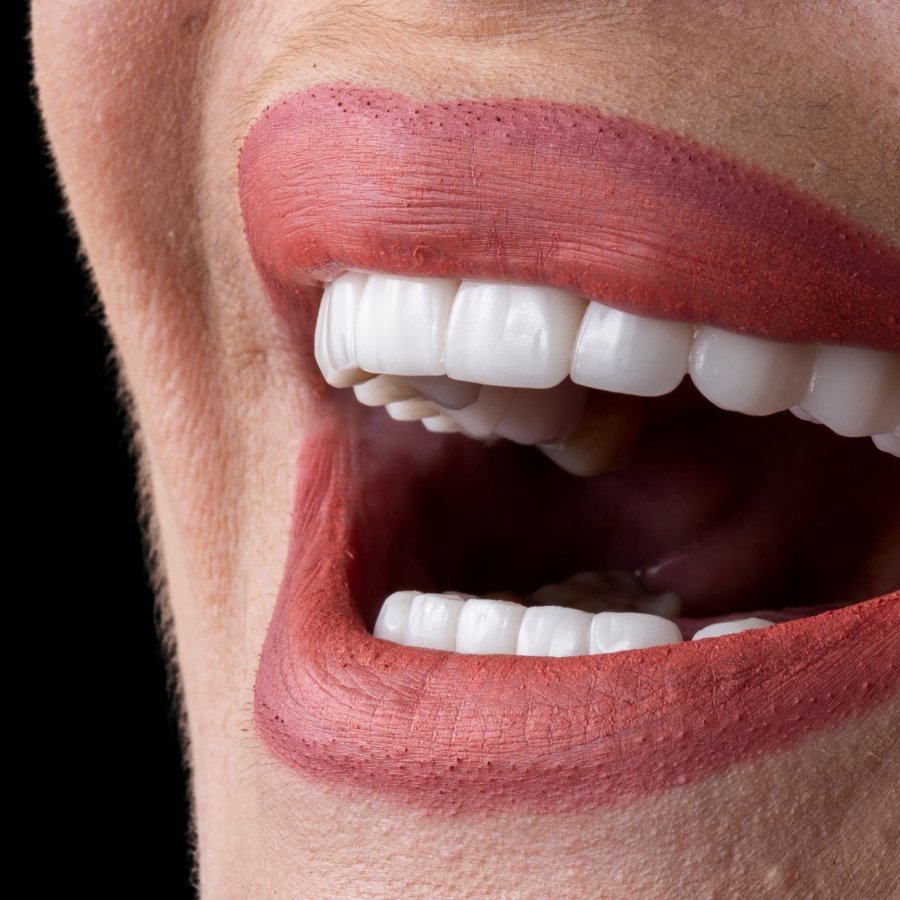 Premium porcelain veneers at Mary St Dental Gympie providing custom smile makeovers with natural-looking tooth enhancement solutions