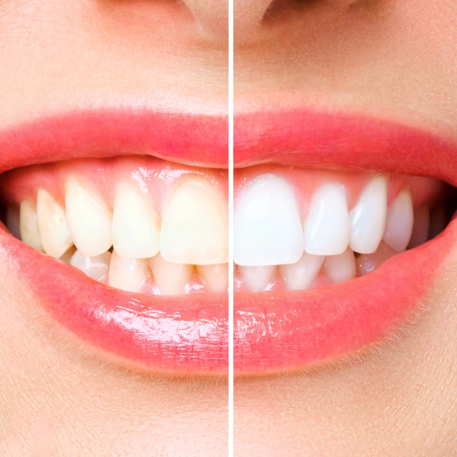 Professional teeth whitening at Mary St Dental Gympie delivering brilliant white smiles through advanced cosmetic dental technology