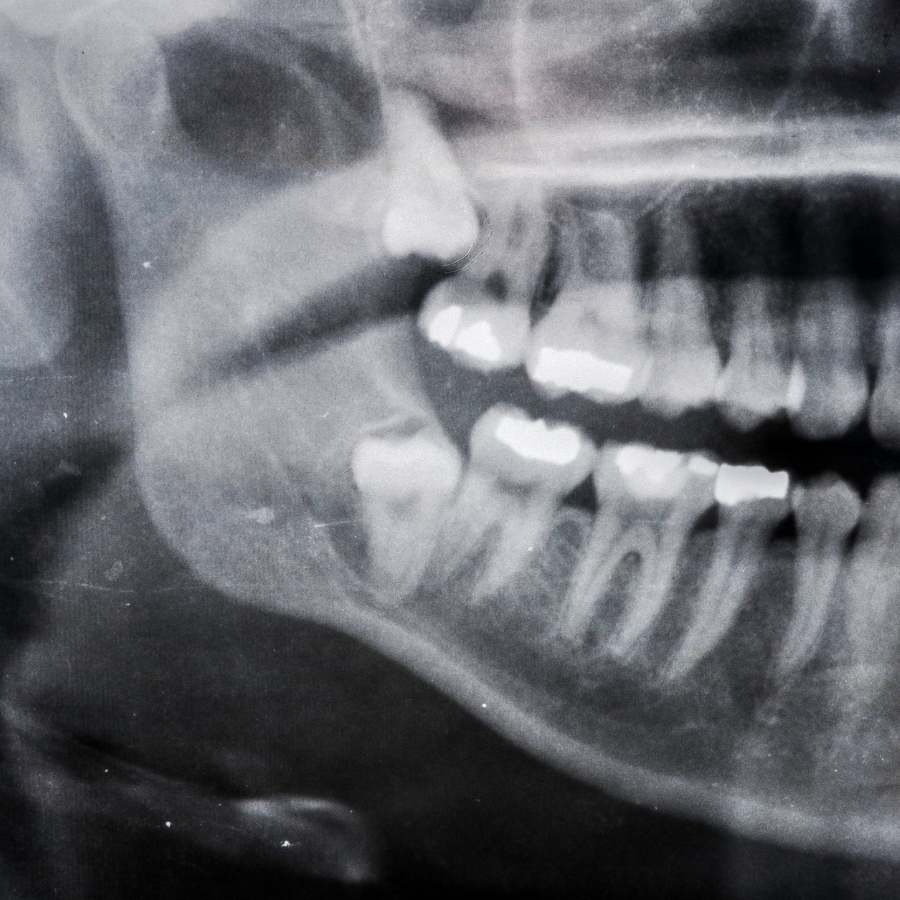 Professional wisdom teeth extraction at Mary St Dental Gympie providing expert oral surgery with comprehensive patient care and comfort