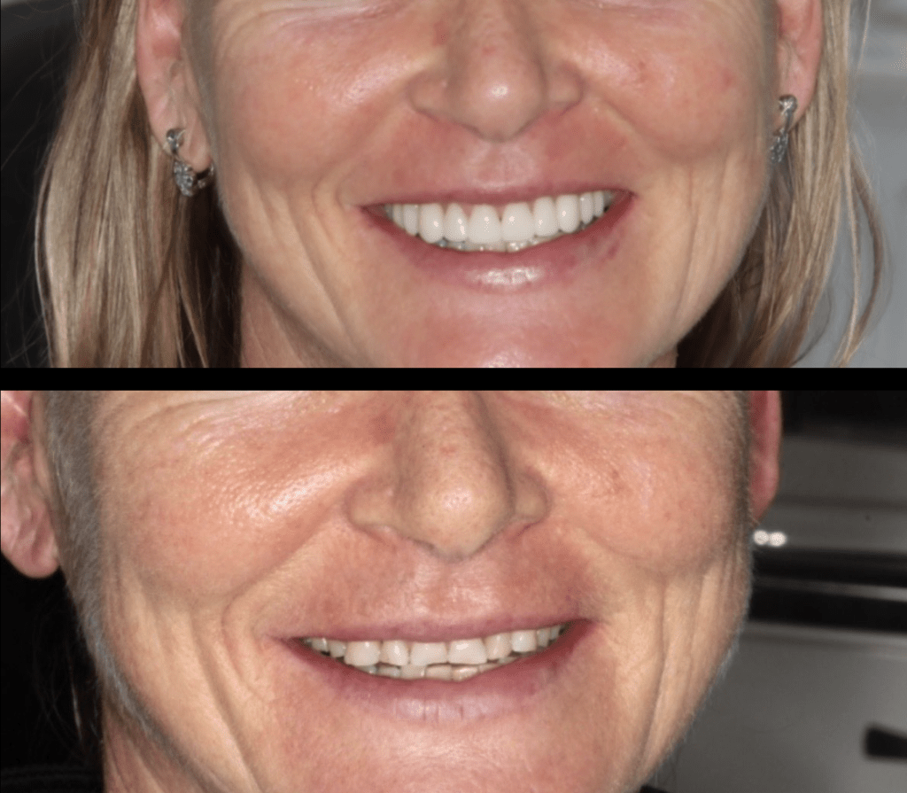 Digital scan of dental crown or bridge design at Mary St Dental Gympie