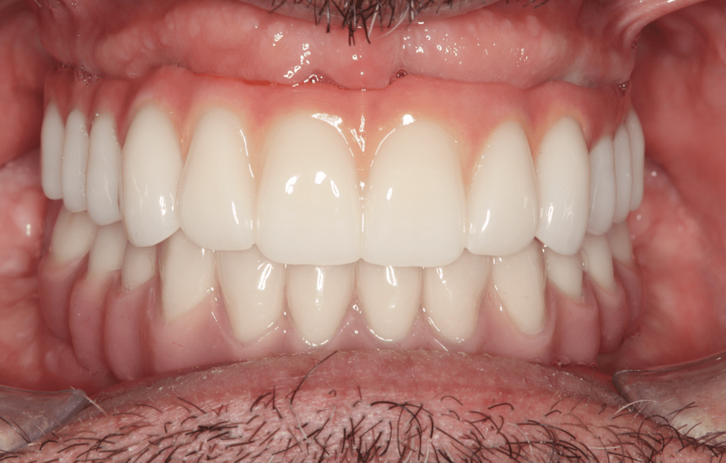 Implant-supported overdenture technology at Mary St Dental Gympie