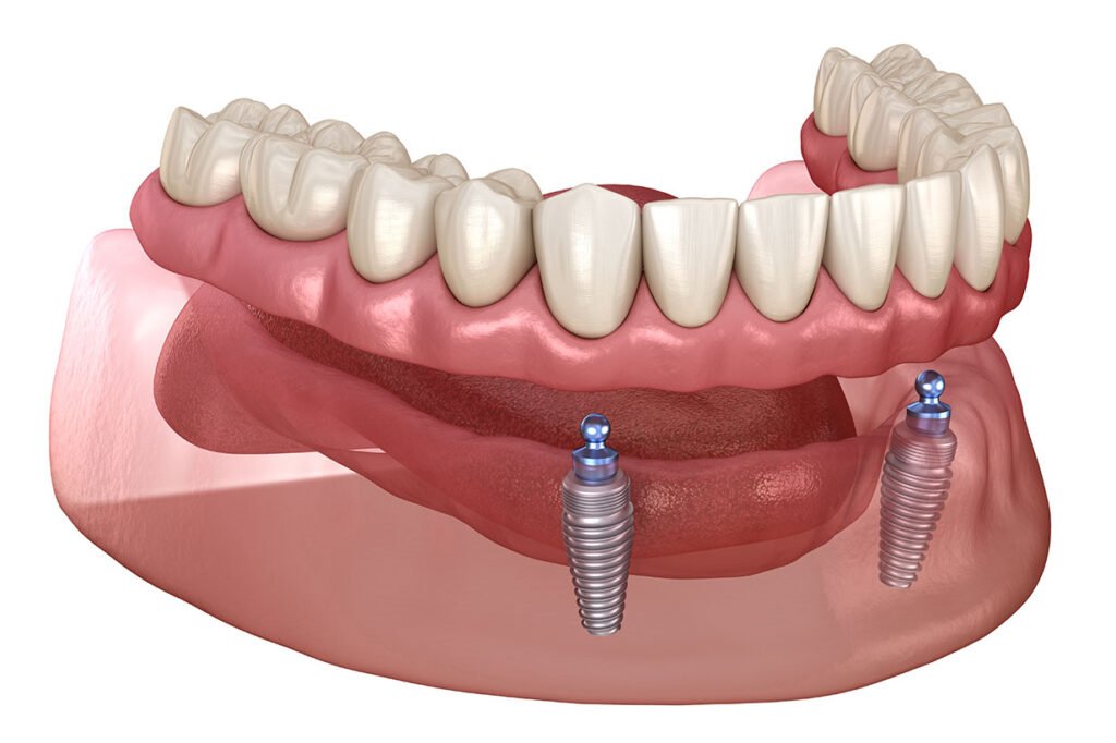 Implant-supported overdentures treatment at Mary St Dental Gympie