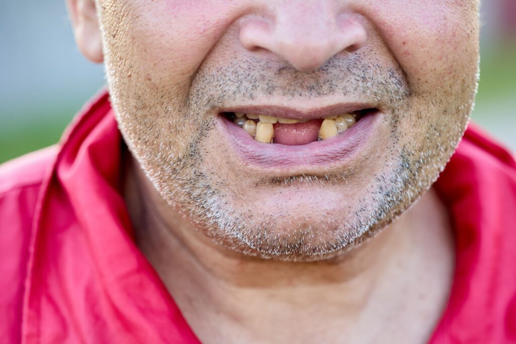 Patient consultation for missing teeth treatment options at Mary St Dental Gympie