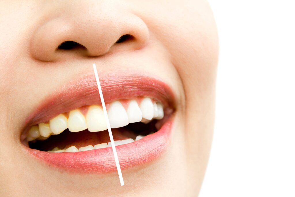 Professional teeth whitening services at Mary St Dental Gympie for brighter, whiter smiles and enhanced confidence
