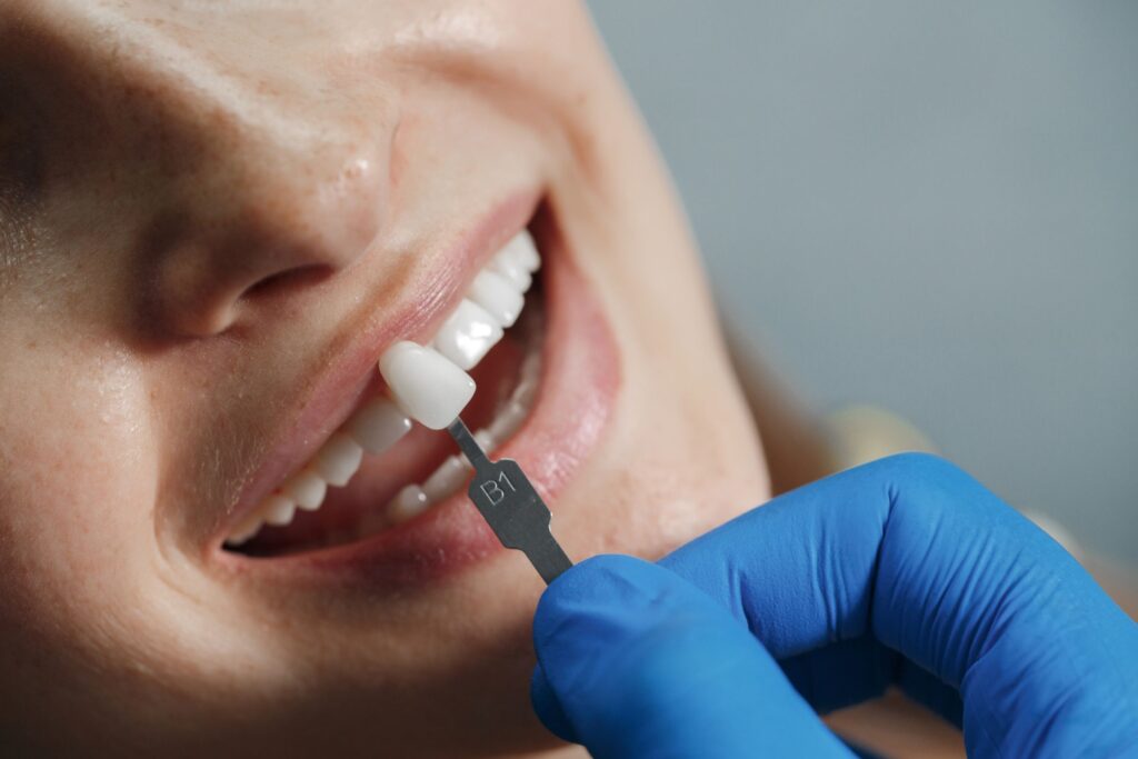 Porcelain veneers consultation at Mary St Dental Gympie - cosmetic smile solutions for Tin Can Bay and Wide Bay patients