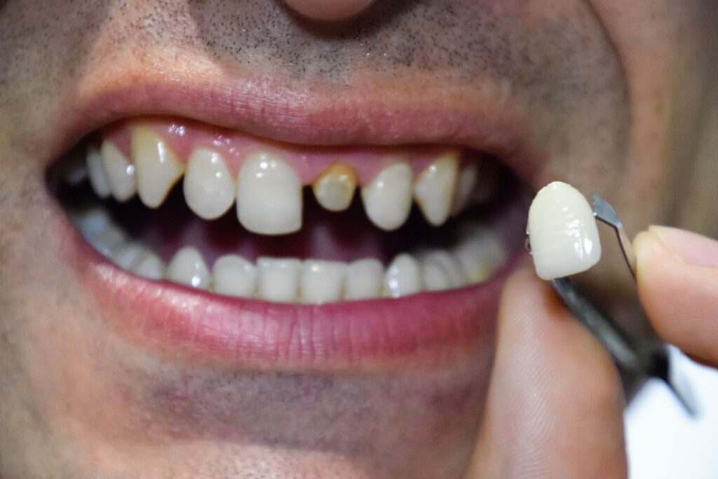 Same-day dental crowns at Mary St Dental Gympie providing convenient single-visit crown restorations