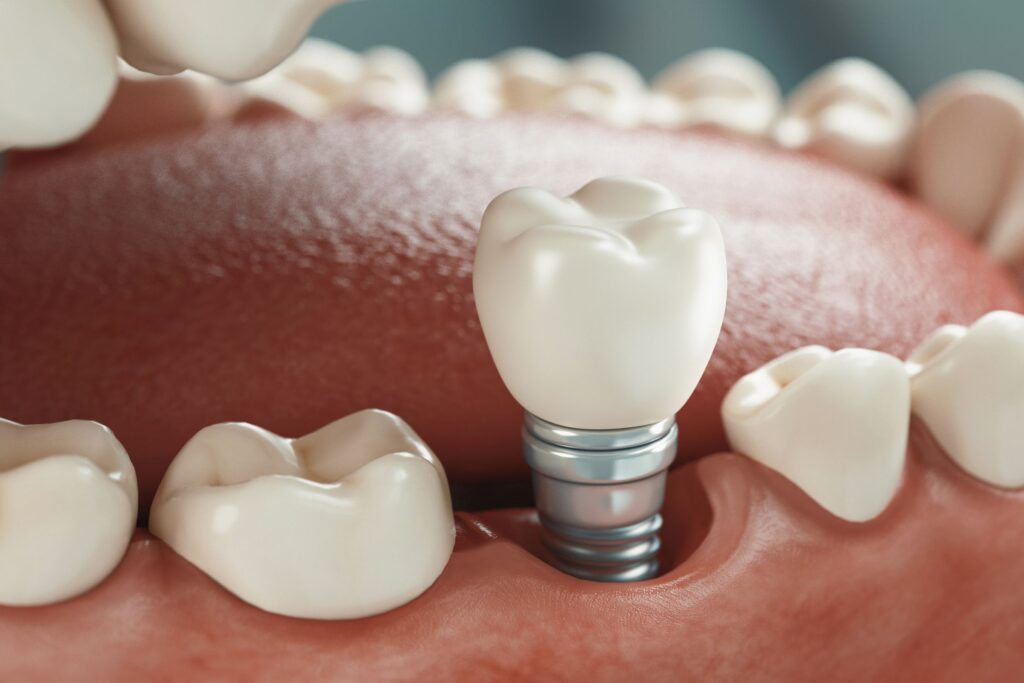 Comprehensive dental implant treatment planning and consultation at Mary St Dental Gympie