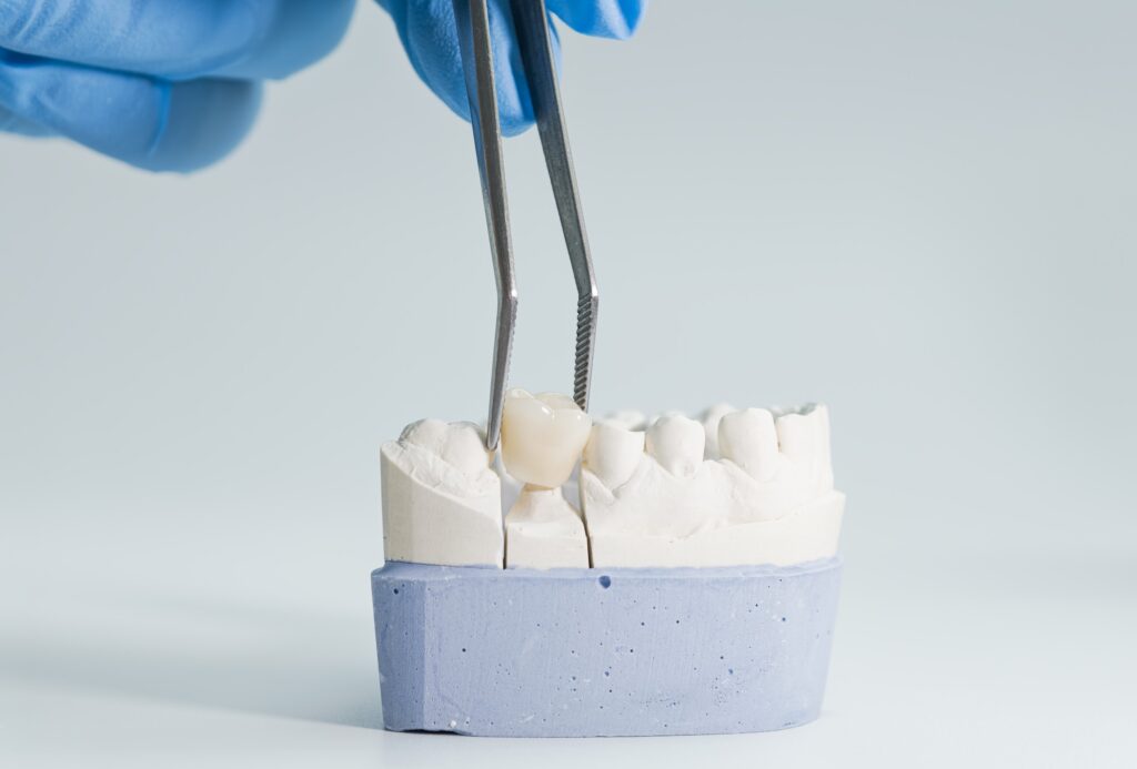 Traditional dental crowns displayed on a model, illustrating restorative dentistry options at Mary St Dental Gympie