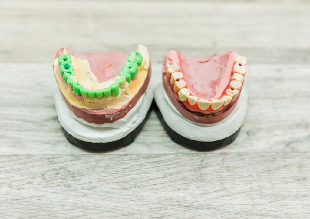 Dental implants vs dentures comparison showing dental models used for tooth replacement