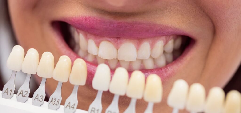 Dental crowns treatment at Mary St Dental in Gympie