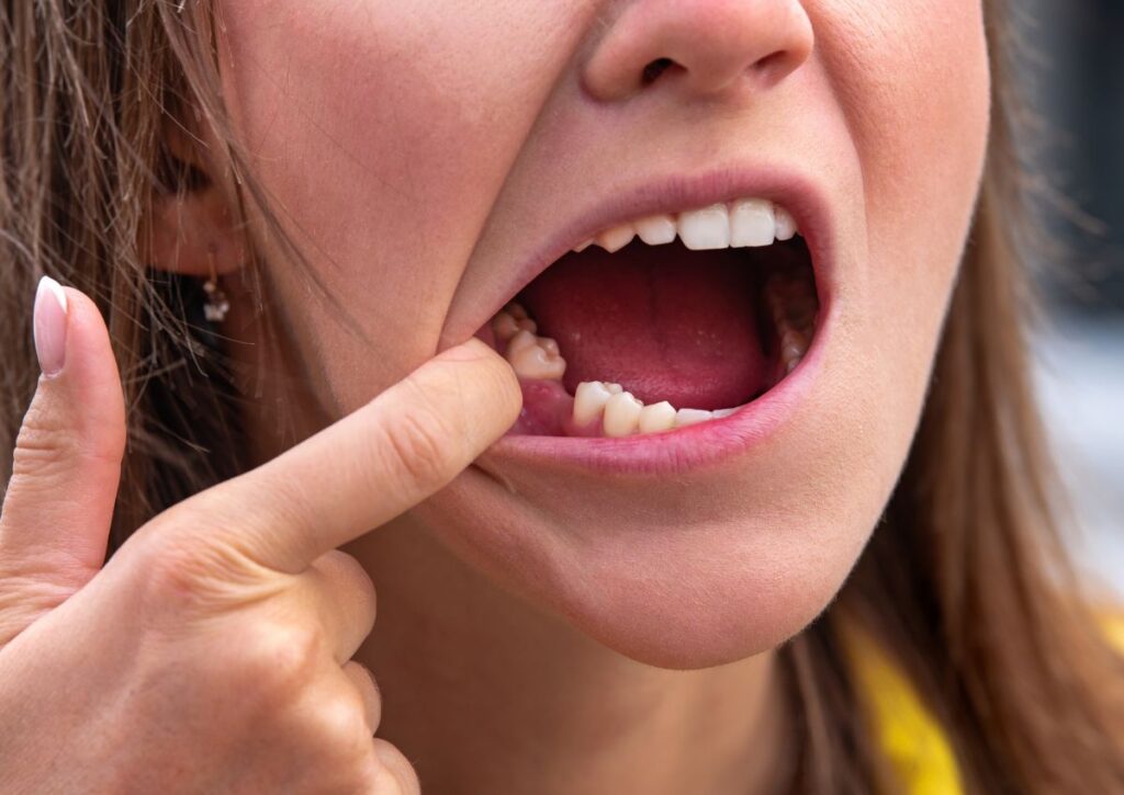 Patient pointing to gap caused by missing tooth needing missing teeth treatment near Widgee