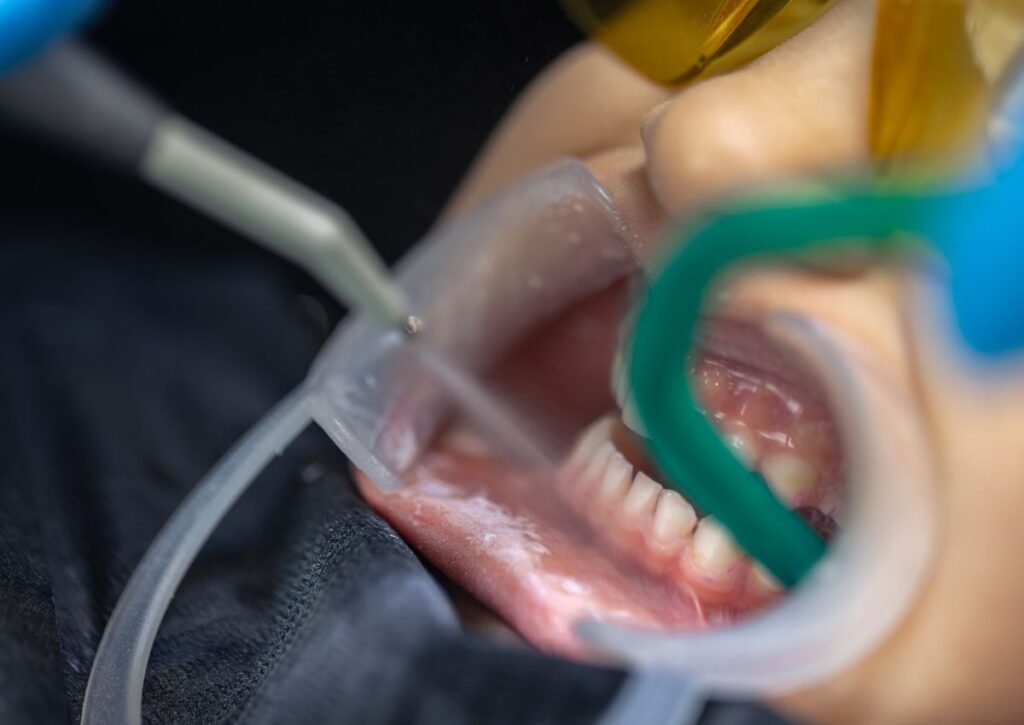 Sedation dentistry Gympie patient receiving relaxed dental treatment