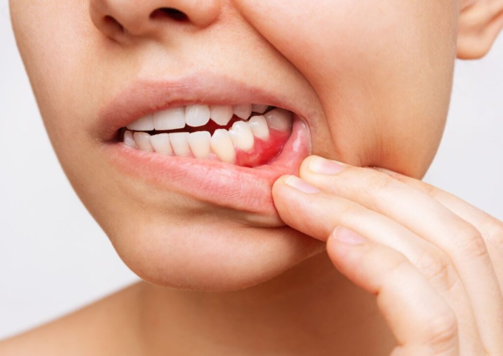 Bleeding gums showing early signs of gum disease needing treatment in Gympie