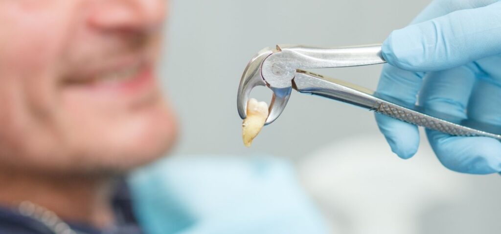 Tooth extraction procedure at Mary St Dental in Gympie