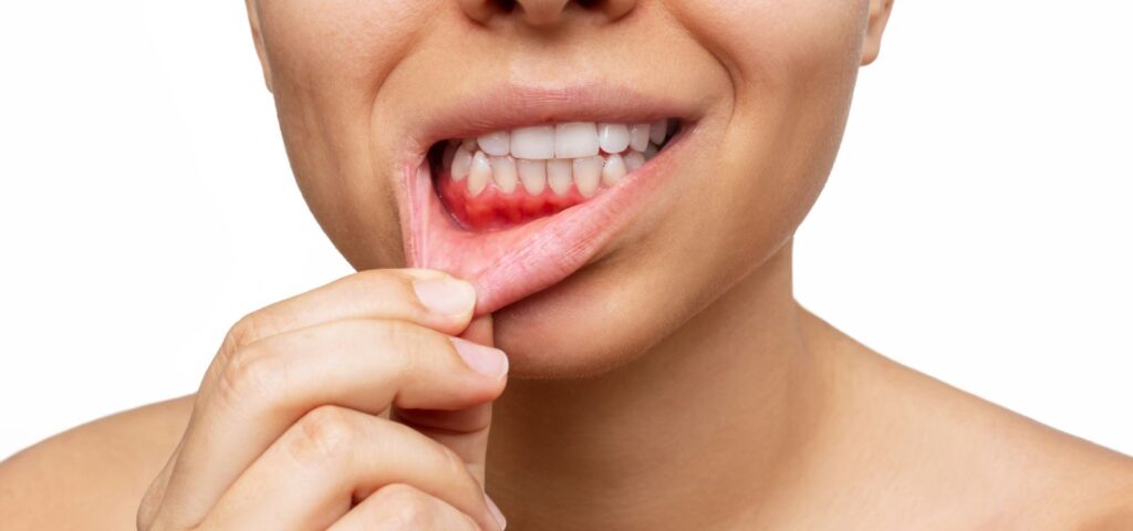 Dental treatment for bleeding gums at Mary St Dental Gympie